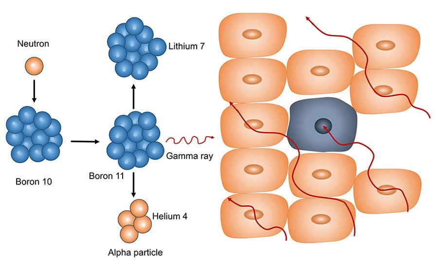 Diagram of the two stages of boron neutron capture therapy: a boron-10 compound accumulating in a cancer cell, then neutron irradiation releasing alpha particles and lithium nuclei.
